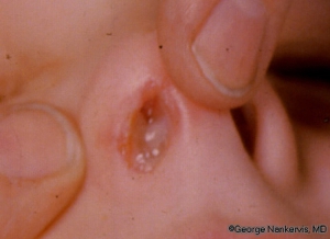 Difteri pada Hidung