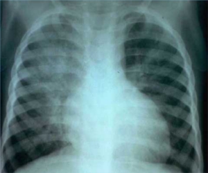 Komplikasi Pneumonia dari Difteri