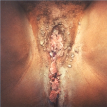 HPV pada Vagina