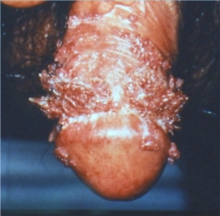 HPV pada Penis