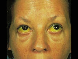 Mata Kuning Penderita Hepatitis A