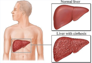Cirrhosis dibanding Liver Sehat