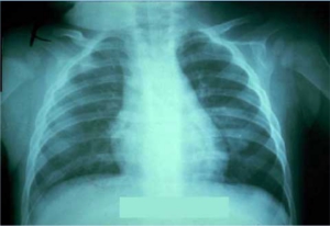 Komplikasi Pneumonia dari Hib